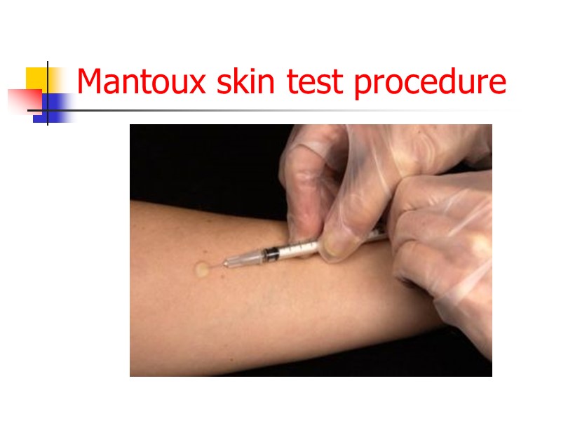 Mantoux skin test procedure